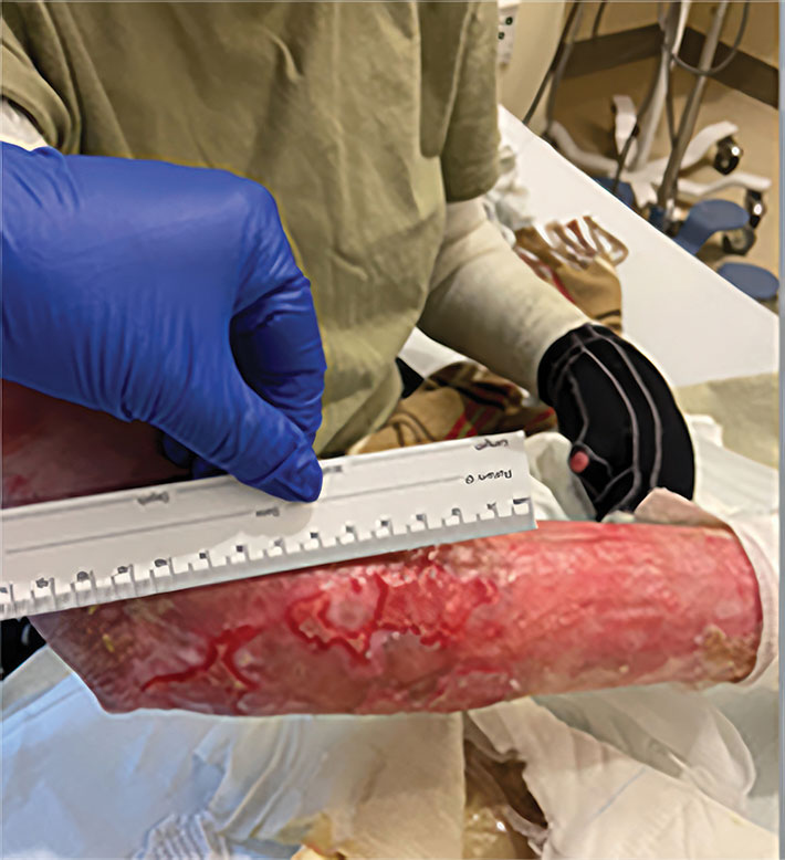 Example of an RDEB wound at the arm before treatment with ZEVASKYN