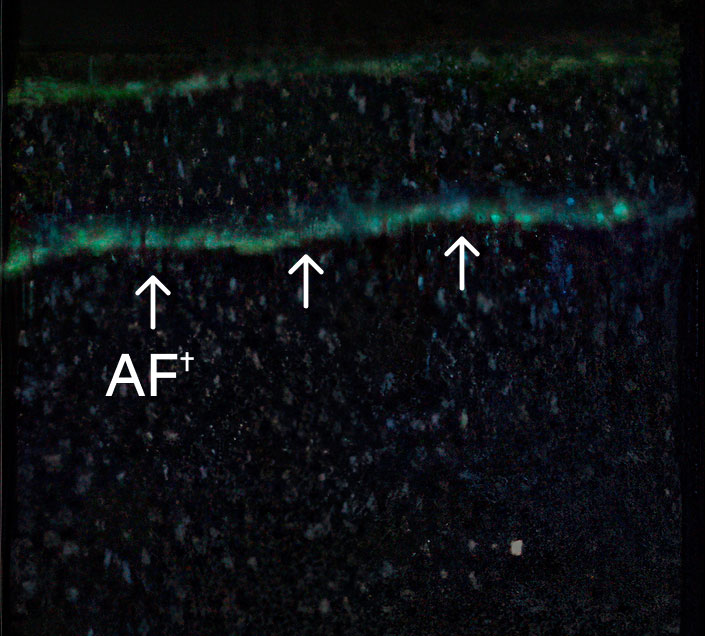 12-months presence of anchoring fibrils at treated site