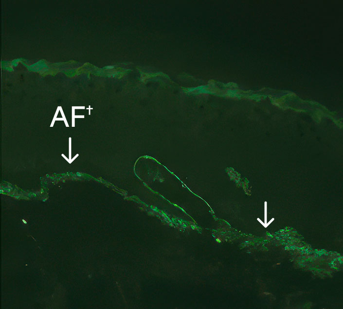 24-months presence of anchoring fibrils at treated site