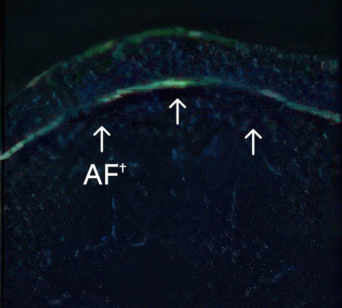 3-months presence of anchoring fibrils at treated site