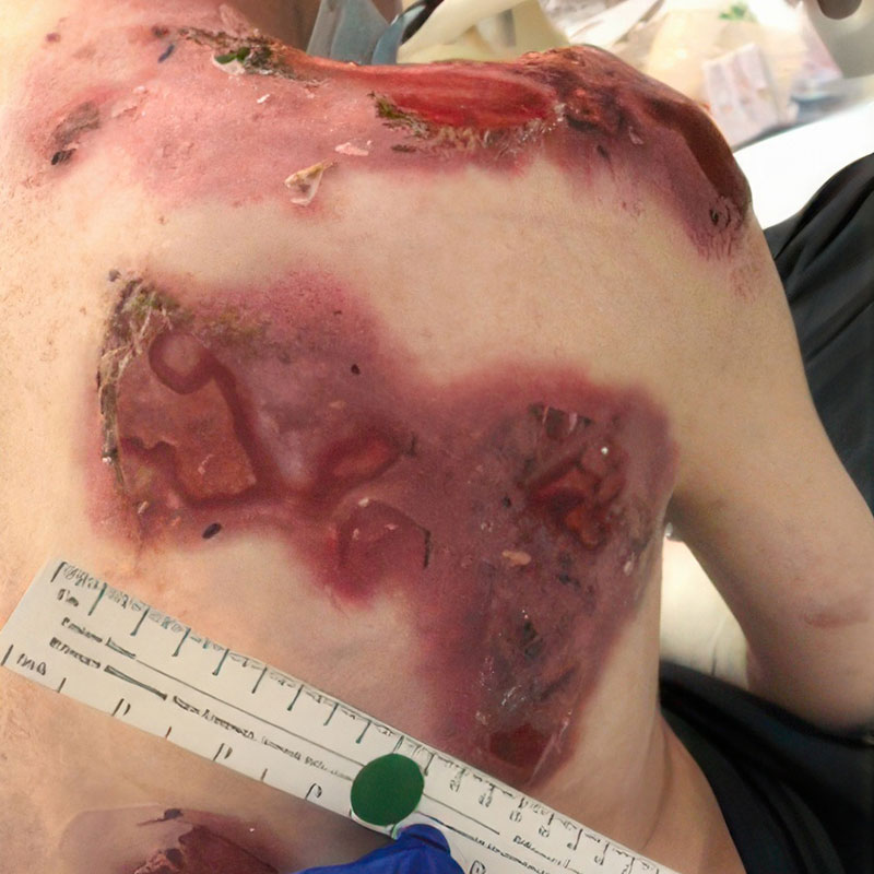 Baseline RDEB wound at the back before treatment with ZEVASKYN
