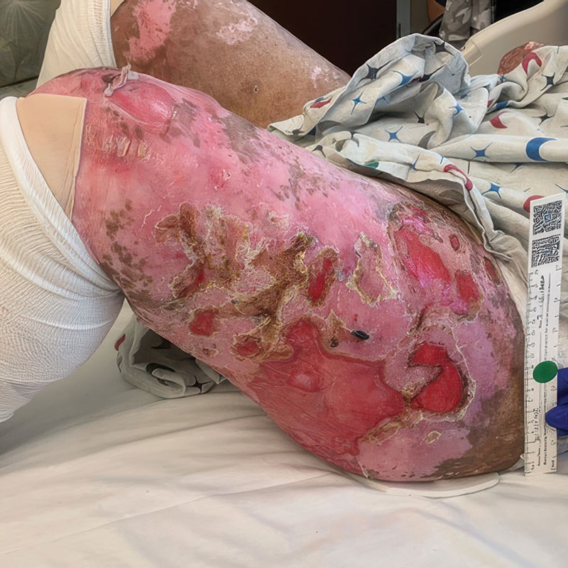 Example of wound before treatment with ZEVASKYN