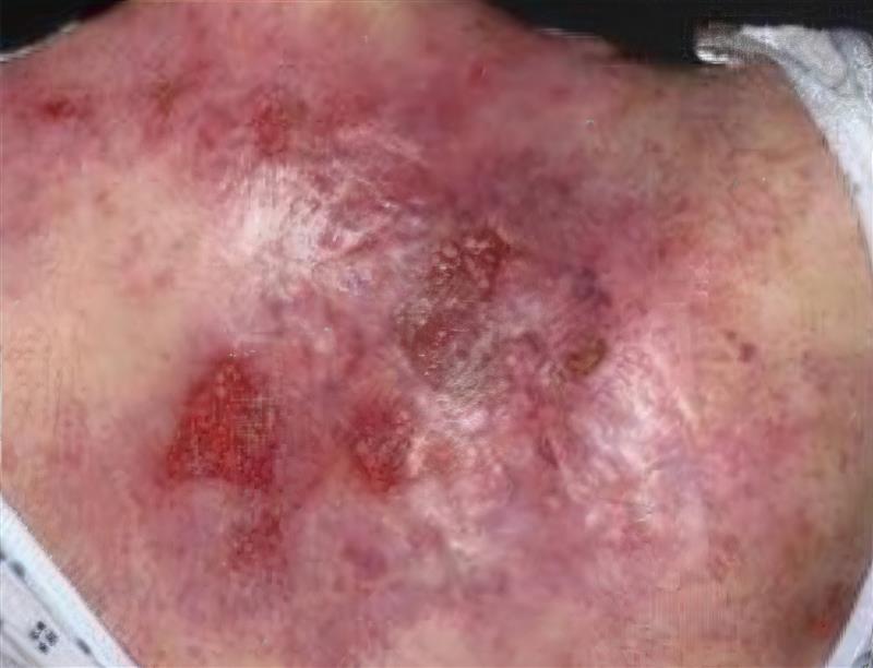 RDEB wound at back before treatment