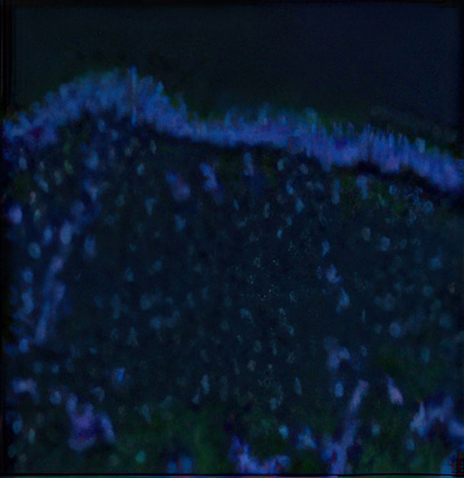 Baseline absence of anchoring fibrils