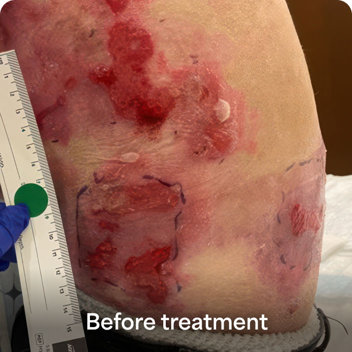 Before ZEVASKYN treatment baseline wound