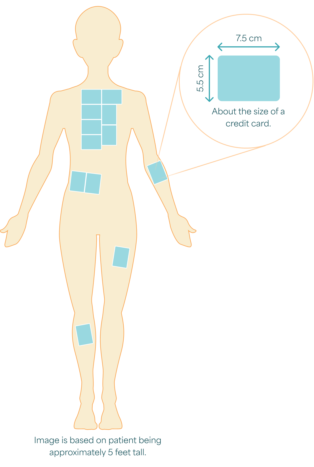 Diagram of ZEVASKYN placement on patient