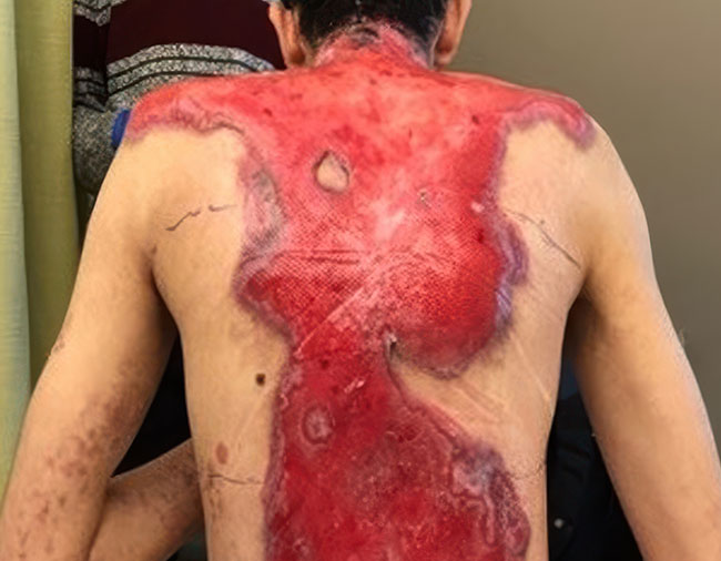 Untreated RDEB wounds on the back