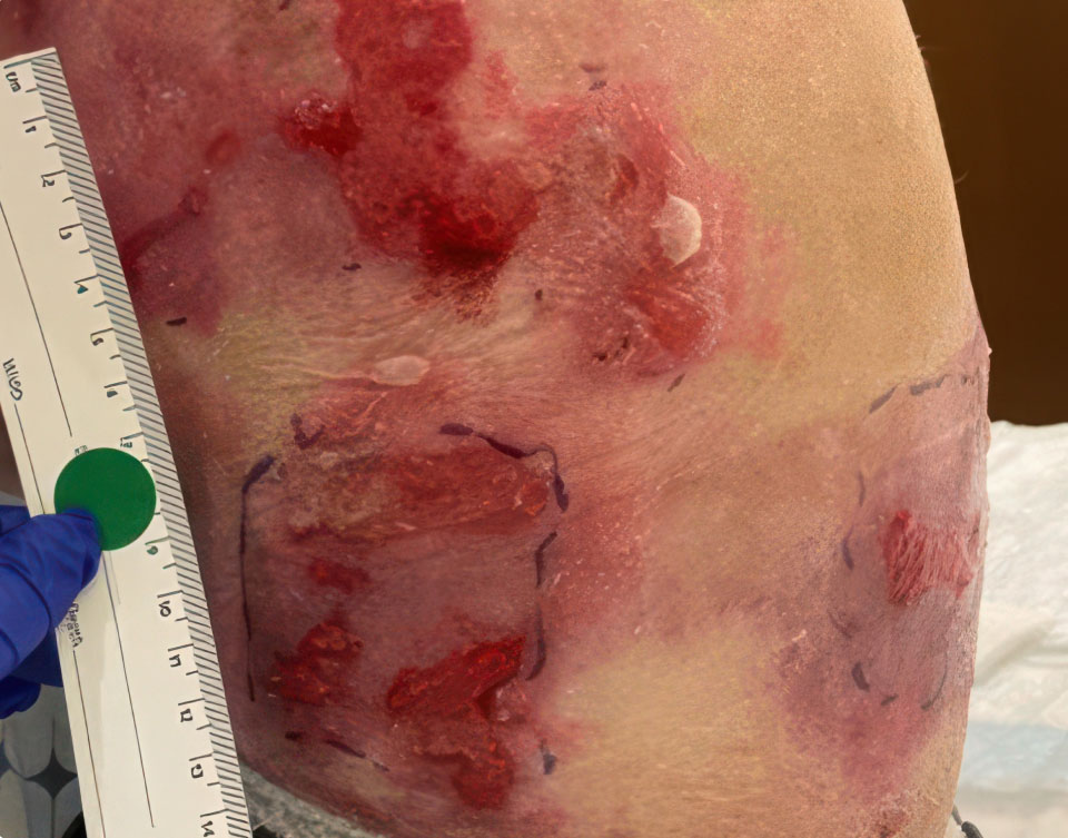 RDEB wounds on patient's torso