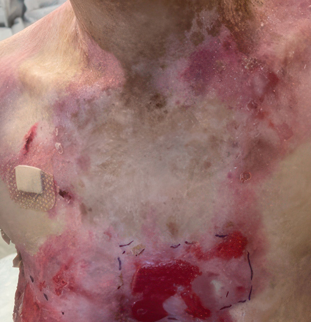 Chest - Before