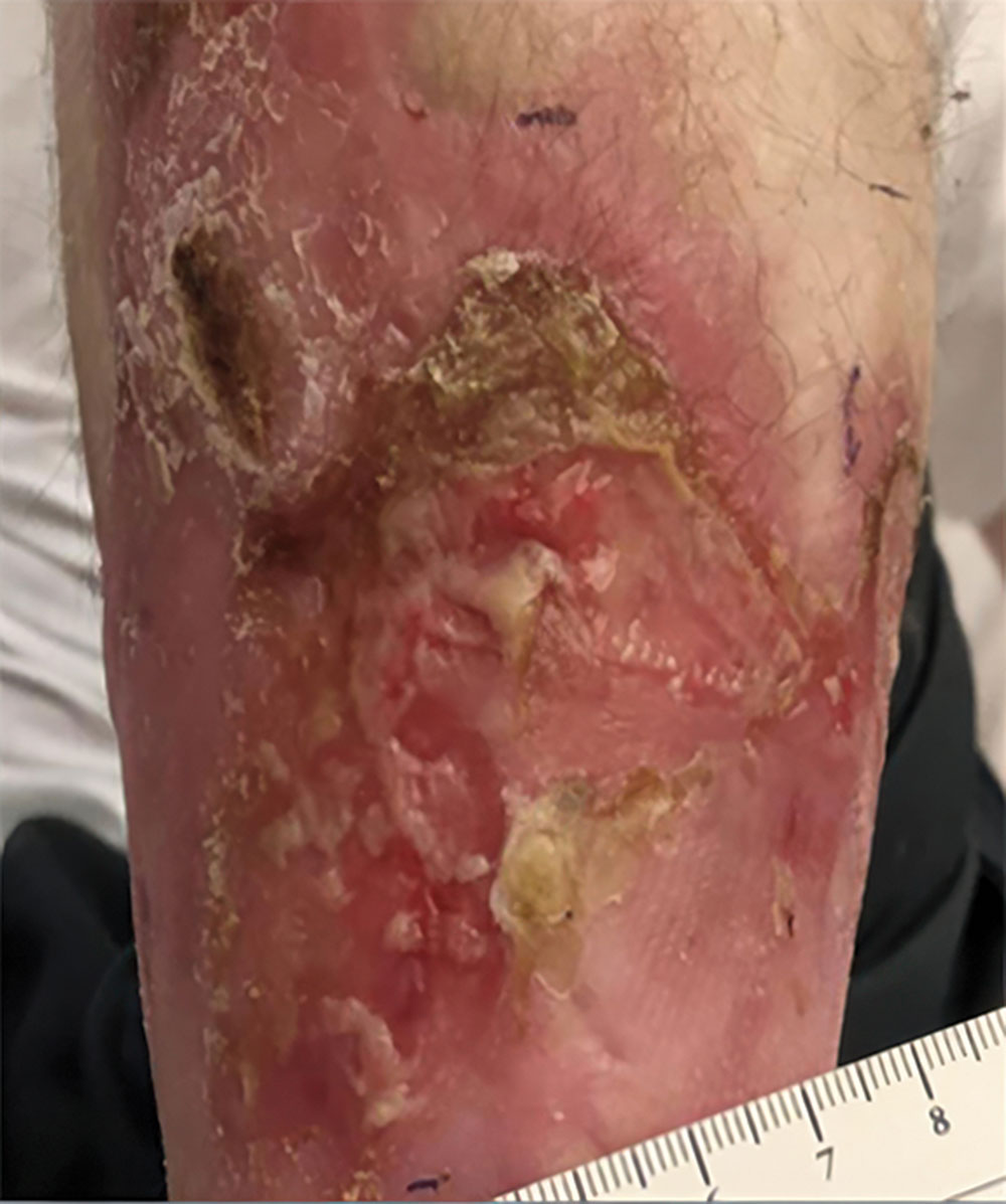 Left leg - Before