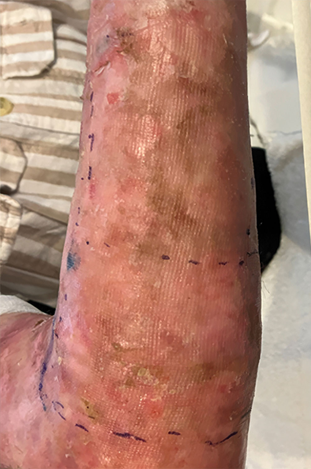 Right arm - After