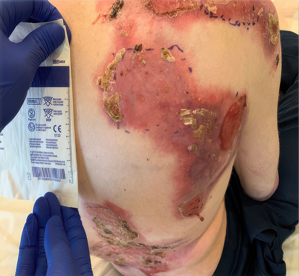 Upper back - After