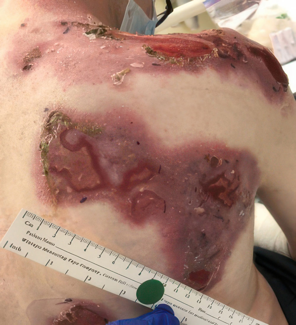Upper back - Before